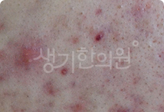 고름이 보이는 농포 참고 사진