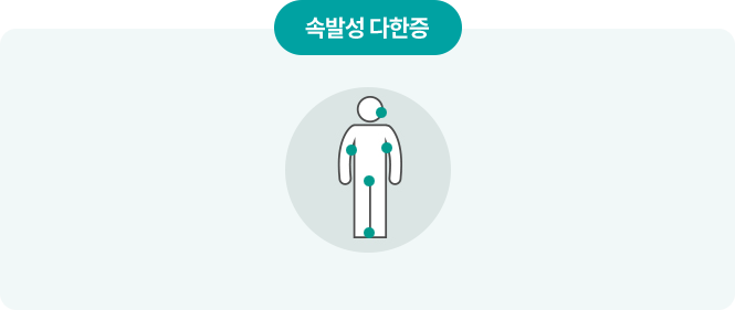 이차성 다한증에서 확인하는 전신 발한 설명도