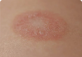 붉은 병변의 가장자리에 각질이 보이는 모습