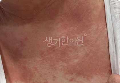 가려움·건조·갈라짐 참고 사진