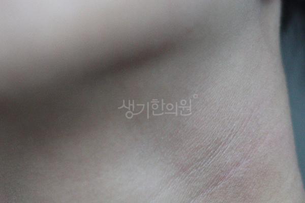 아토피 치료 후